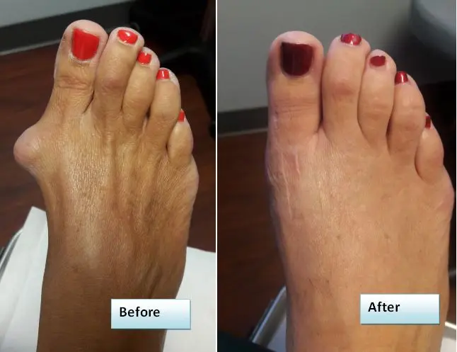 Bunion Surgery